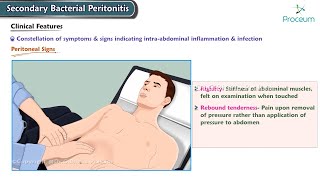 Secondary Bacterial Peritonitis Etiology Clinical features Diagnosis Management Surgery [upl. by Cusick]