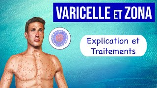 Varicelle et Zona  Explication et traitements [upl. by Willis]