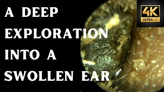 A Deep Exploration Into A Swollen Ear 4K 60FPS [upl. by Erreid421]