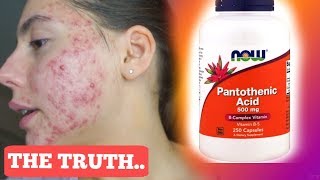 I TOOK PANTOTHENIC ACID FOR ONE MONTH STRAIGHT  THIS IS WHAT ACTUALLY HAPPENED TO MY ACNE [upl. by Lowndes]