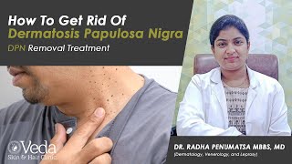 DPN  How To Get Rid Of Dermatosis Papulosa Nigra  DPN Removal Treatment  Dr Radha Penumatsa [upl. by Nnav318]