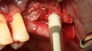 Sinus elevation  Crestal approach using Sinus Elevator amp NR Line system [upl. by Eciuqram759]