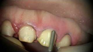 Dr Basil Mizrahi Tooth preparation refinement [upl. by Weidner598]