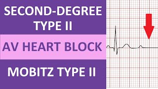 SecondDegree Type 2 Heart Block ECG Rhythm Nursing NCLEX  Mobitz Type II [upl. by Stephanie]