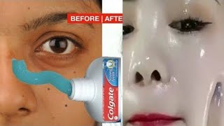 Colgate toothpaste for face whitening whitens skin rejuvenates tightens shrinks skin pores [upl. by Luella]