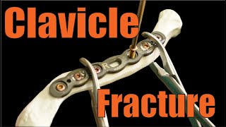 Fixing CLAVICLE FRACTURES [upl. by Einej]