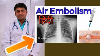 air Embolism in hindi injection bubble [upl. by Alecia]