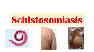 Schistosomiasis  Bilharziasis  Causes Symptoms and Treatment [upl. by Nyrak]