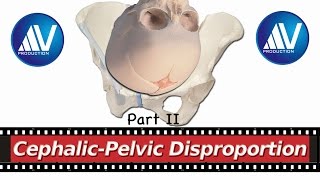 Contracted Pelvis Part II [upl. by Nowed]