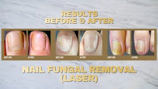 Fungal Nail Treatment  Fotona Laser [upl. by Chladek257]