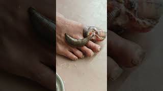 LEECH THERAPY IN DIABETIC ULCER REWAAYURVEDA [upl. by Ellinnet]