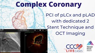 PCI of pLCx and pLAD with dedicated 2 Stent Technique and OCT Imaging  September 18 2018 [upl. by Heid]