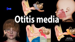 Otitis Media Anatomy Pathophysiology Risk Factors Types of OM Symptoms and Treatment Animation [upl. by Amal]