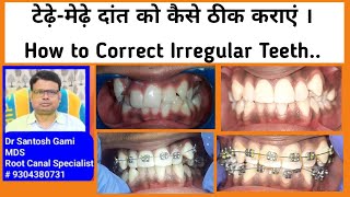 टेढ़े मेढ़े दांत को कैसे ठीक कराएं । How to Correct Irregular Teeth [upl. by Mahau]