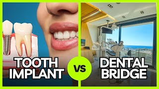 Tooth Implant vs Dental Bridge 🦷 Which to Choose ⏬👇 [upl. by Allis662]