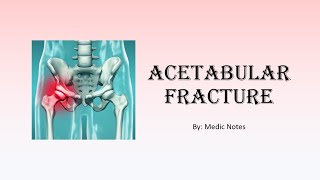 Acetabular fracture  clinical feature investigation treatment [upl. by Bray]