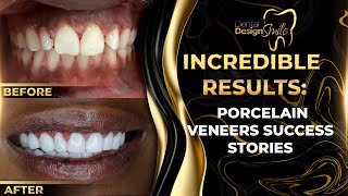 Incredible Results Porcelain Veneers Success Stories [upl. by Reta]