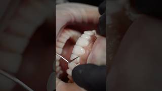 “Veneers transforms smiles creating confident happy patients” dentist dental viralvideo [upl. by Calvin]