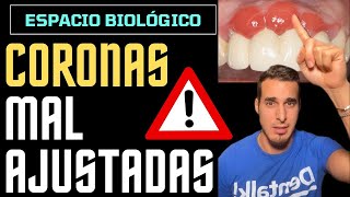 Así le quedaron las ENCÍAS por unas CORONAS mal ajustadas  ESPACIO BIOLÓGICO PERIODONTAL [upl. by Atterehs]