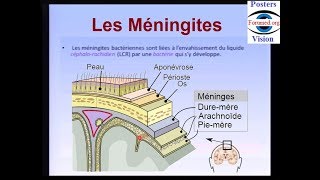 Méningite bactérienne cérébro spinale maladie infectieuse [upl. by Baryram]