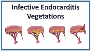 Vegetations Infective Endocarditis  NEET PG  Pathology  Medicine [upl. by Doehne]