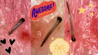 Super Satisfying Hair Follicle Plucks Big Juicy Roots amp Sheaths Hair Plucking Under the Microscope [upl. by Kinnie]