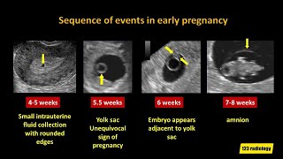 Early Pregnancy Failure A simplified Ultrasound Approach [upl. by Nimrahc]