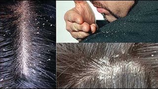 Como Eliminar a Caspa Seborreia e Fazer Crescer Muito o Cabelo [upl. by Ahseekat]