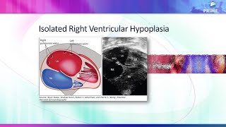 5 Signs of RV Hypoplasia in the Fetus [upl. by Zoe]