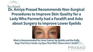 How Under Eye Wrinkles That Appear When Smiling can be Helped with NonSurgical Treatment [upl. by Cletus]