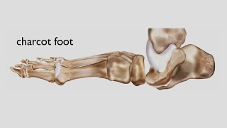 Charcot Foot [upl. by Flita41]