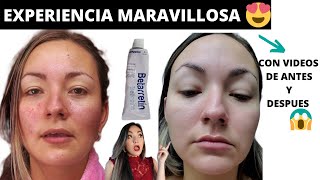 RETINOL ANTES Y DESPUES😱 TRETINOINA MI EXPERIENCIA DESPUES DE 6 MESES betarretin acido retinoico [upl. by Alyworth]