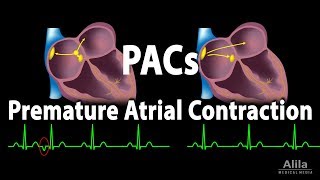 Premature Atrial Contractions PACs Animation [upl. by Utimer]