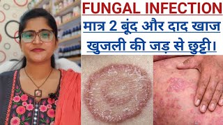 दाद खाज खुजली का जड़ से इलाज।।Fungus amp Tinea Treatment।।Ringworm Treatment।।khujli and daad ki dawa। [upl. by Maurreen]