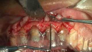 Anterior Esthetic Crown Lengthening [upl. by Mosby]