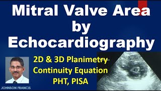 Assessment of Mitral Valve Area by Echo  3D Planimetry PHT PISA [upl. by Shellie111]