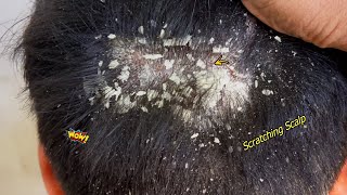 Itchy Dry Scalp Treatment 862  Seborrheic dermatitis [upl. by Adnilrev]