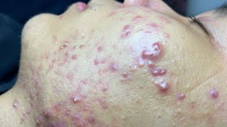 ACNE TREATMENT VU QUYNH MI Blackheads On Boy Face 2024 [upl. by Ahsimot]