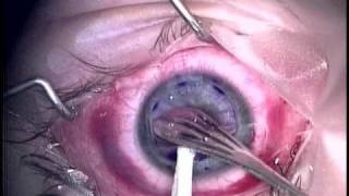 Corneal Transplant 1 [upl. by Ress264]