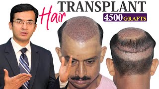 4500  5000 Grafts Hair Transplant Procedure in 1 Day  Dr Suneet Soni at Medispa India [upl. by Lori]