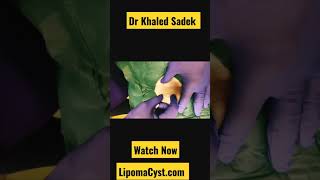 Bikini Line cysts are no fun Dr Khaled Sadek Full video online cystremoval blackheads pimples [upl. by Anatnahs]