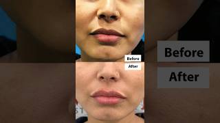 ⚡Lip Transformation  💋 Lip Filler Treatment Before and After  short shortsfeed [upl. by Zwiebel]