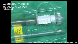 GUARDUS™ Overtube Intragastric Balloon Retrieval [upl. by Neelrahc]