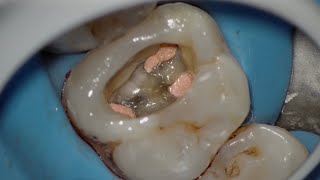 Retreatment for upper 1st molar [upl. by Annayat]