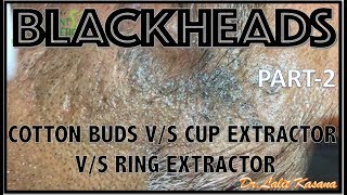 OLD BLACKHEAD REMOVAL WITH COTTON BUDS vs EXTRACTORS PART2 by DRLALIT KASANA [upl. by Osman]