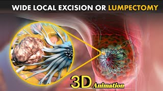 What is a Lumpectomy or Wide Local Excision How Lumpectomy surgery is Performed  Breast Cancer [upl. by Anirba496]