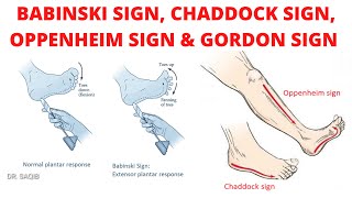 Babinski sign  Chaddock sign  Oppenheim sign  Gordon sign [upl. by Chow]