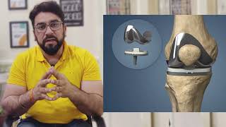 OA knee braces perfect alternate of kneesurgey for osteoarthritis patient घुटने के दर्द से राहत [upl. by Haiel]