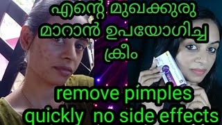 Remove pimples and acne in one week easy and simple method [upl. by Einnek]