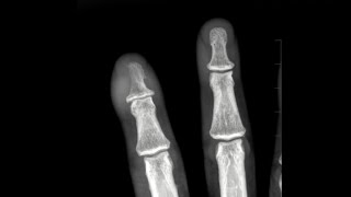 Osteomyelitis of the finger [upl. by Simara]